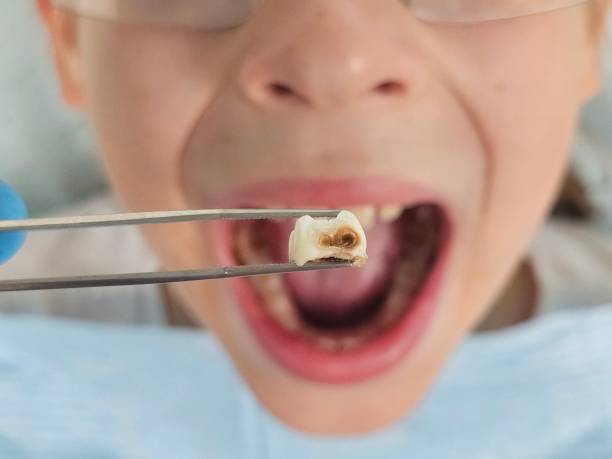 Best Emergency Dentist for Knocked-Out Tooth in Crystal River, FL